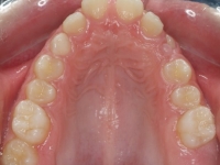 01-07--076-Upper Occlusal-02072015