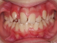 03-04--073-Anterior Bite-01012006.jpg