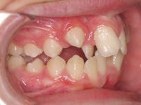 03-05--075-Right Bite-01012006.jpg