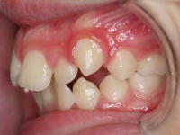 03-06--074-Left Bite-01012006.jpg