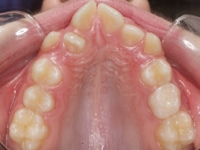 03-07--076-Upper Occlusal-01012006.jpg