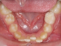 03-08--077-Lower Occlusal-01012006.jpg