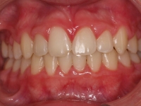 07-04--073-Anterior Bite-24092014.jpg