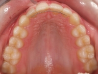 07-07--076-Upper Occlusal-24092014.jpg