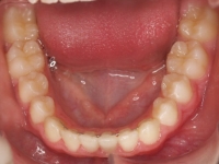 07-08--077-Lower Occlusal-24092014.jpg