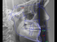 01-01-steiner-170-lateral-xray-16032011