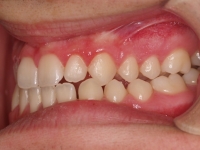 02-06-074-left-bite-16032011