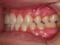 06-06-074-left-bite-01012006