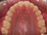 06-07-076-upper-occlusal-01012006