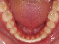 06-08-077-lower-occlusal-01012006