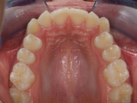 01-07-076-upper-occlusal-24022010