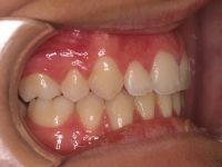 04-05-075-right-bite-01012006