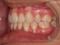 04-06-074-left-bite-01012006