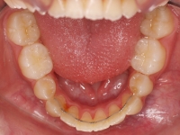 04-08-077-lower-occlusal-01012006
