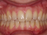 01-04--073-Anterior Bite-01012006.jpg