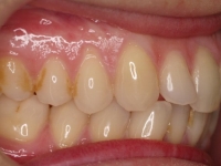 01-05--075-Right Bite-01012006.jpg