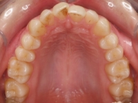 01-07--076-Upper Occlusal-01012006.jpg