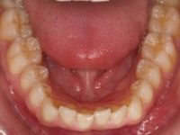 01-08--077-Lower Occlusal-01012006.jpg