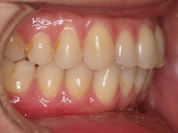 10-01--075-Right Bite-29012015.jpg