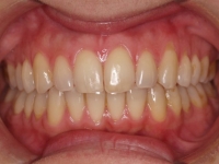 10-02--073-Anterior Bite-29012015.jpg