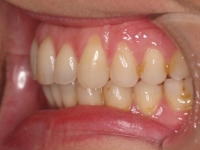 10-03--074-Left Bite-29012015.jpg