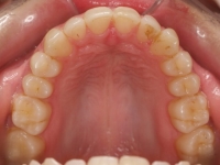 10-04--076-Upper Occlusal-29012015.jpg