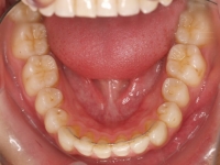 10-05--077-Lower Occlusal-29012015.jpg
