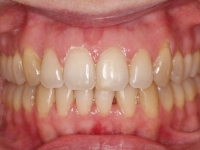 09-04--073-Anterior Bite-20022018