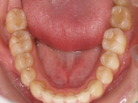 09-08--077-Lower Occlusal-20022018