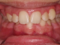 04-04-073-anterior-bite-07042011