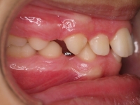 04-05-075-right-bite-07042011