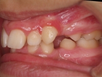 04-06-074-left-bite-07042011