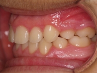 14-03-074-left-bite-01012006