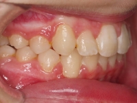 13-05--075-Right Bite-01012006.jpg