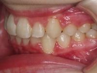 13-06--074-Left Bite-01012006.jpg