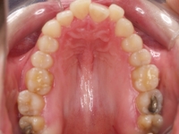 01-07-076-upper-occlusal-12052010-1024x826