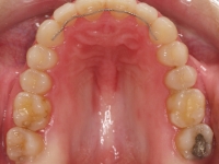 04-07-076-upper-occlusal-01012006