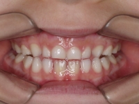 01-04--073-Anterior Bite-18062008