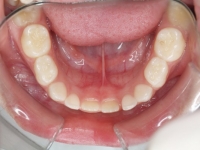 01-08--077-Lower Occlusal-18062008