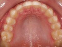 14-07--076-Upper Occlusal-02072015