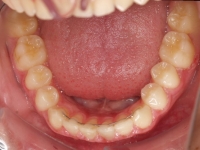 14-08--077-Lower Occlusal-02072015