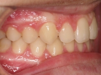 15-01--075-Right Bite-25082015