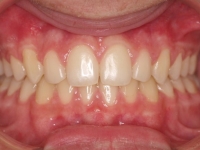 15-02--073-Anterior Bite-25082015