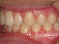 15-03--074-Left Bite-25082015