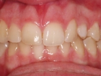 02-04--073-Anterior Bite-24062015