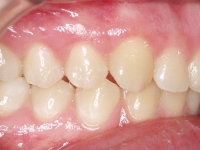 02-05--075-Right Bite-24062015