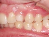 02-06--074-Left Bite-24062015