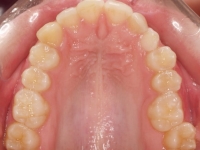 02-07--076-Upper Occlusal-02112015