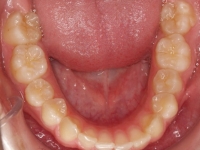 02-08--077-Lower Occlusal-24062015