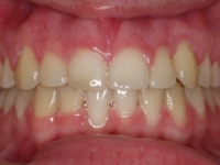 14-04--073-Anterior Bite-06092017